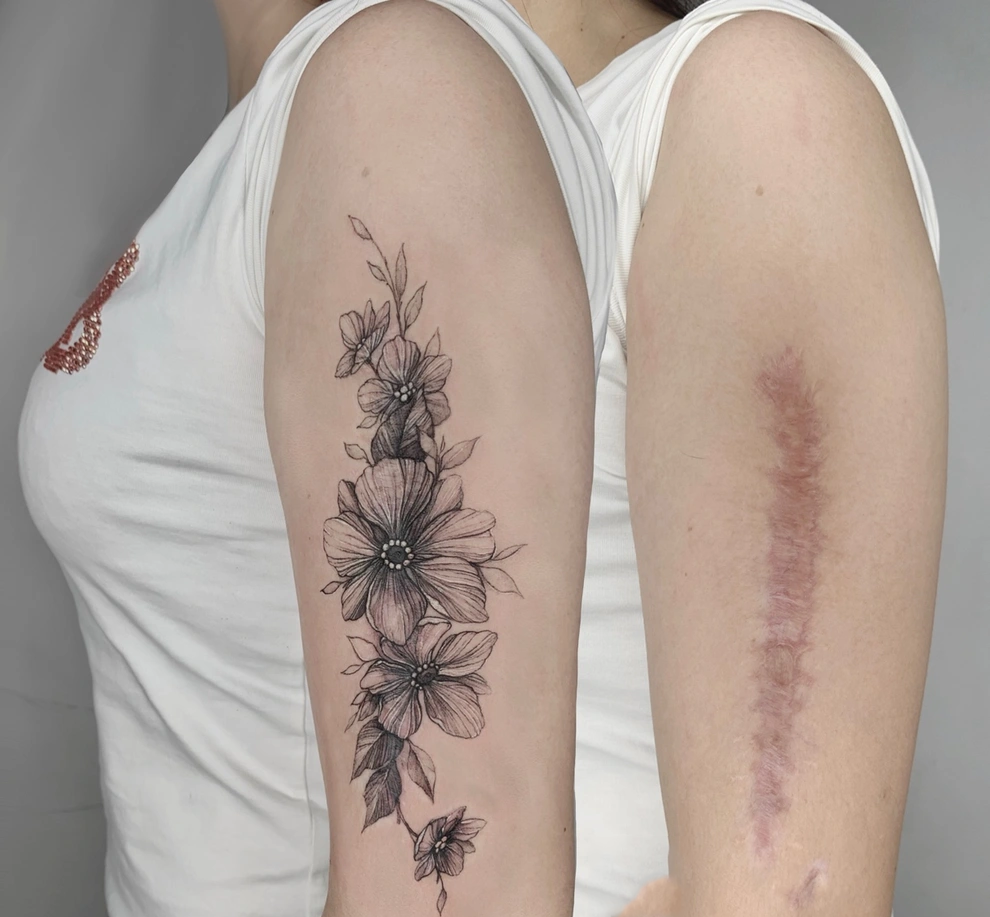 Xăm che sẹo có thực sự hiệu quả không?