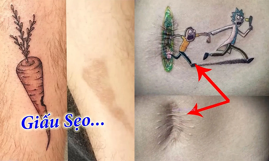 Những điều cần biết trước khi thực hiện xăm che sẹo