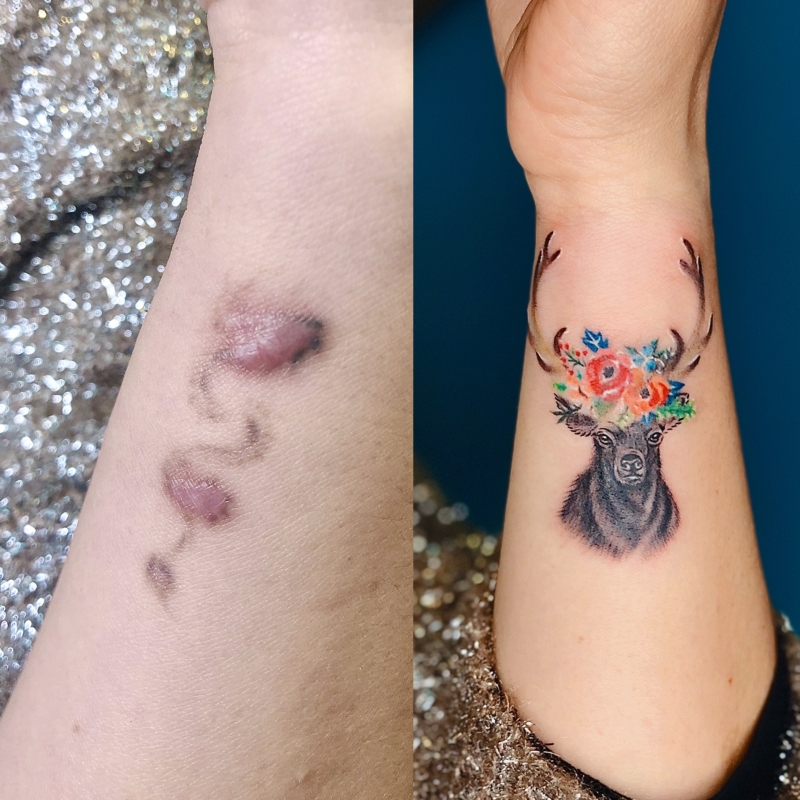 Why are tattoo-covering scars a popular choice?