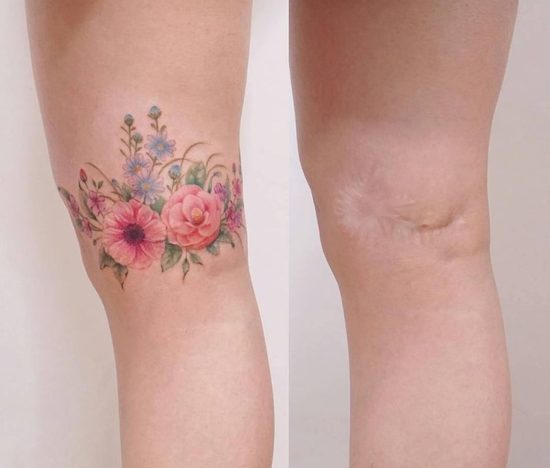 Types of Scars That Can Be Covered with Tattooing