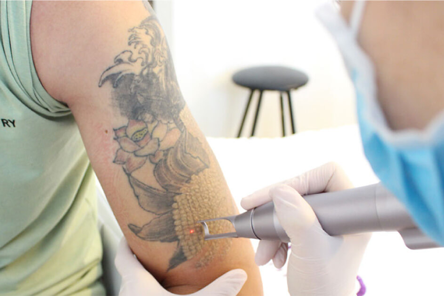 Picosecond Laser Technology - The Ultimate Tattoo Removal Technology at Viet Ink Tattoo