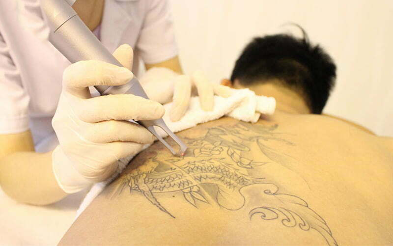 Painless tattoo removal