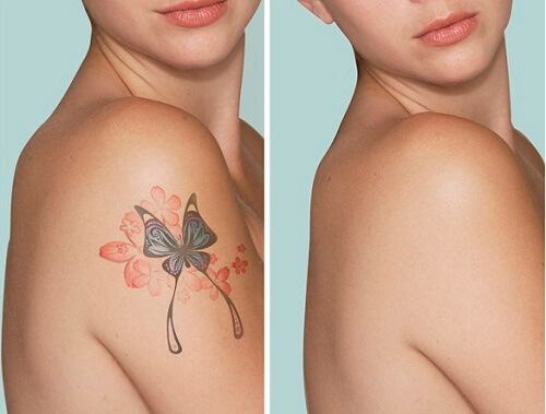 Safe and Effective Tattoo Removal Service Using Modern Technology
