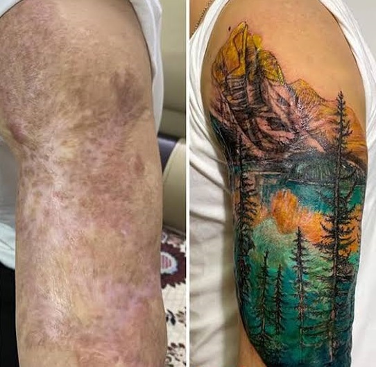 A Collection of Burn Scar Cover-Up Tattoo Designs Suitable for Men and Women 2 Burn scar cover-up tattoo