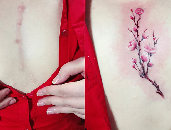 Best Surgical Scar Cover-Up Tattoo Ideas for Unique Body Art 1 Surgical scar cover-up tattoo