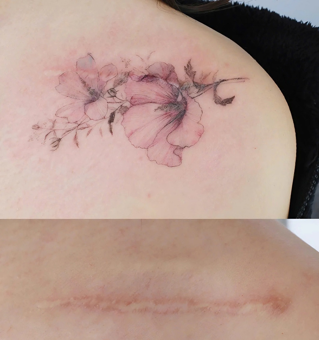 Best Surgical Scar Cover-Up Tattoo Ideas for Unique Body Art 2 Why Choose a Surgical Scar Cover-Up Tattoo?